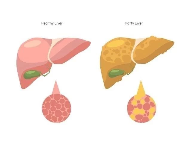 Estéatose hépatique (foie gras) ⁚ causes, symptômes et types